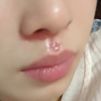 唉 感冒好幾天了都還沒好 鼻子都擦爛擦起泡了😭